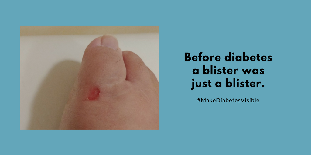 foot blister