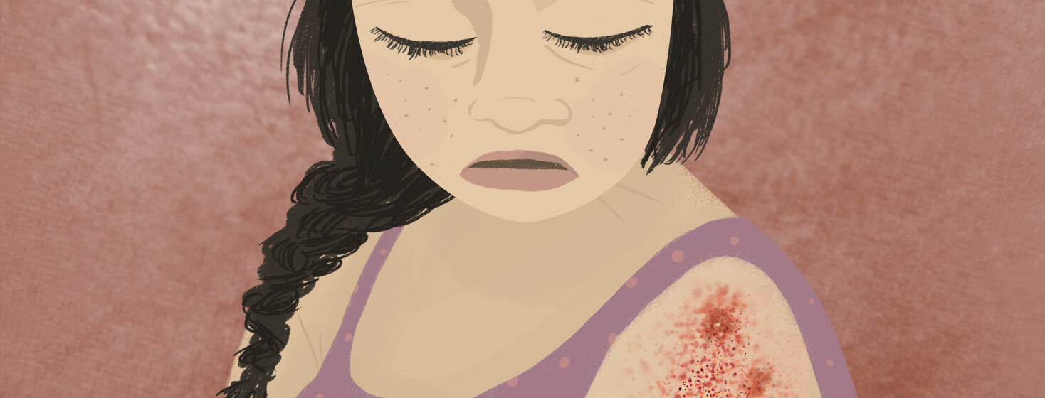 A person wearing a braid looks down at a shingles outbreak on their arm.